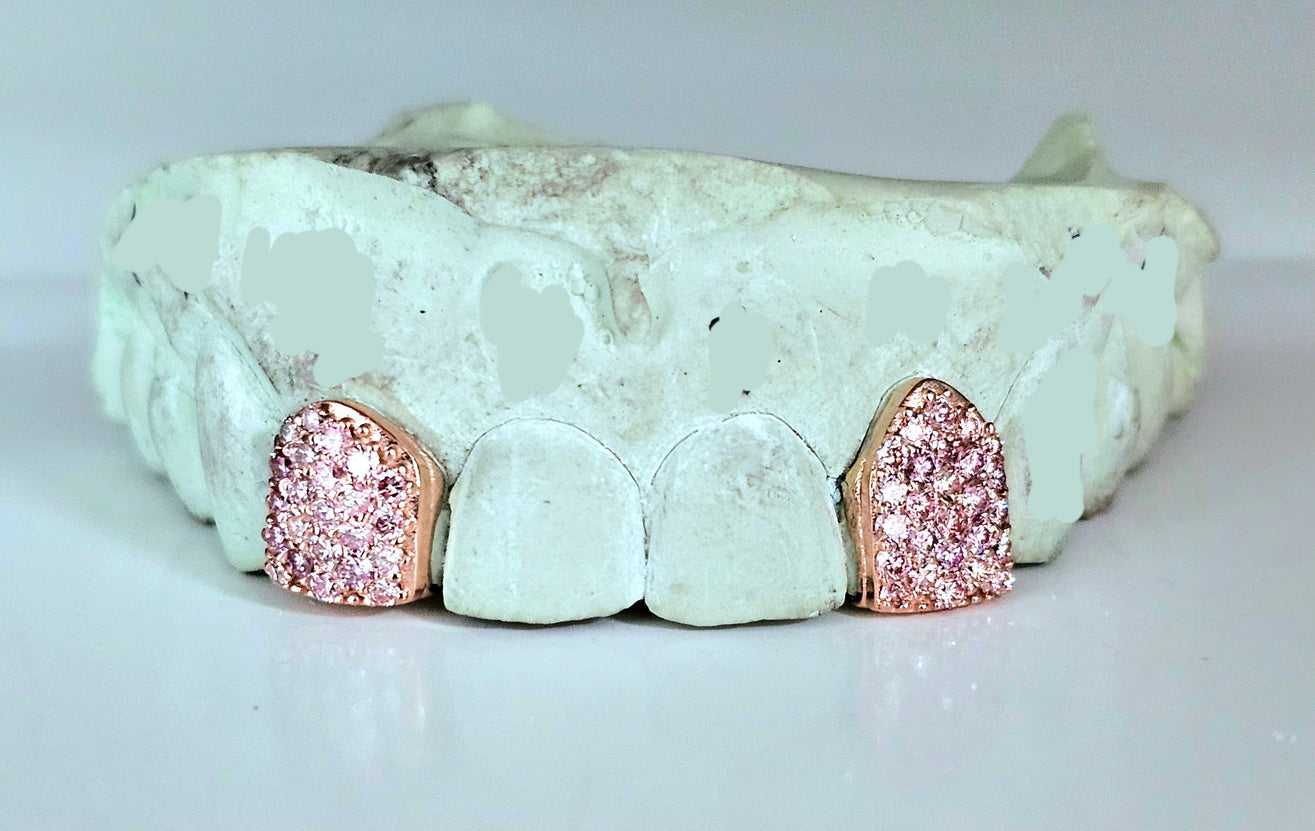 Custom Gemstone Grillz – Premium Gold with Ruby Gemstones DQ1041
