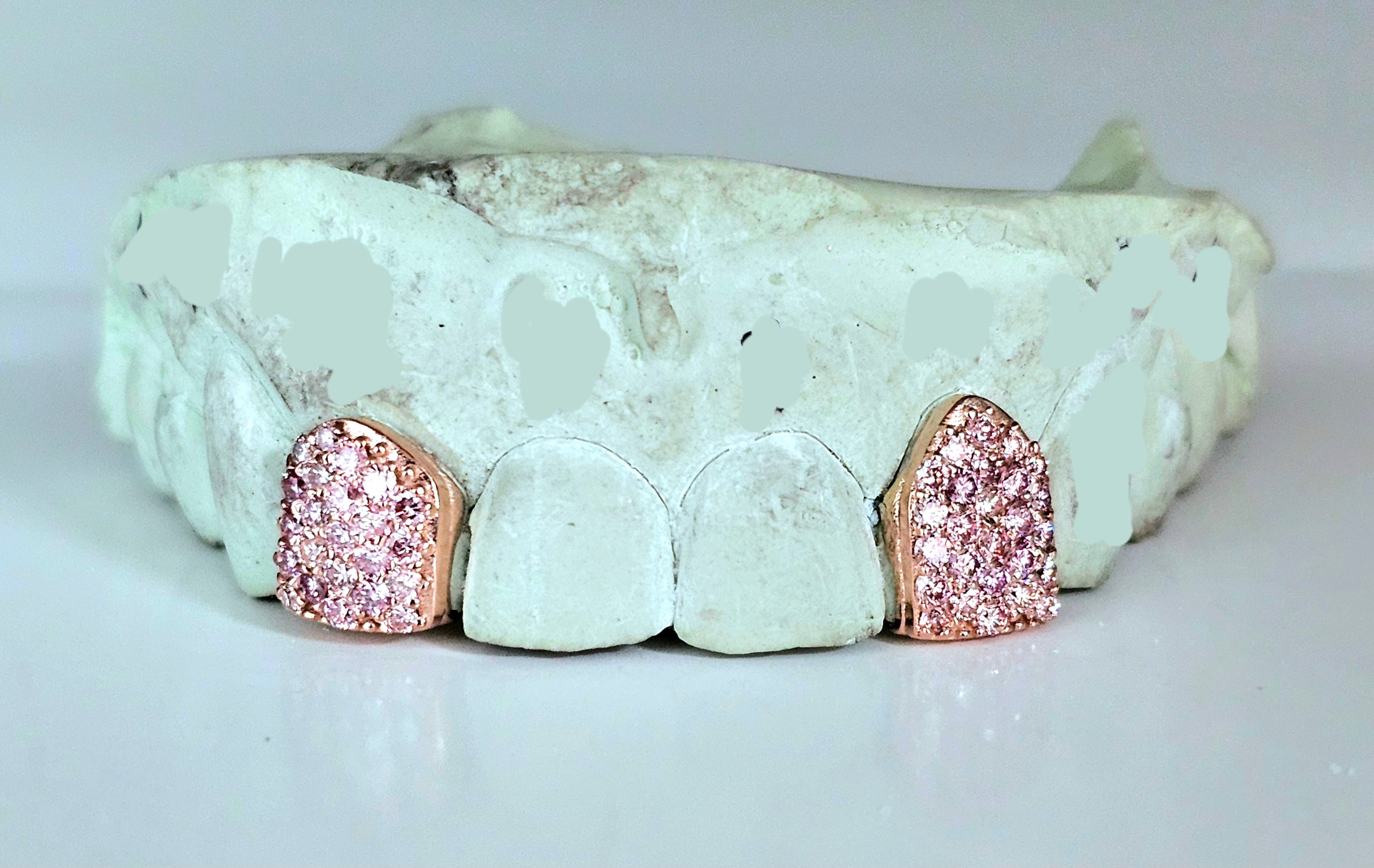 Custom Gemstone Grillz – Premium Gold with Ruby Gemstones DQ1041