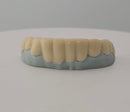 Pop-On Veneers
