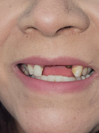 Pop-On Veneers