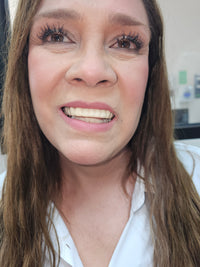 Pop-On Veneers