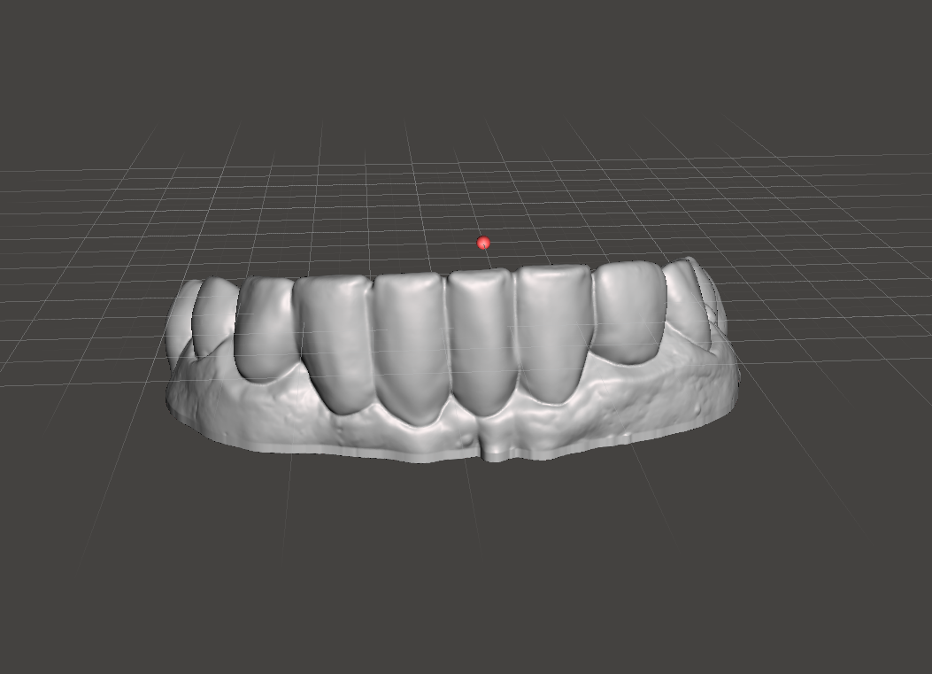 Pop-On Veneers