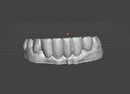 Pop-On Veneers
