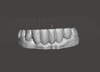 Pop-On Veneers