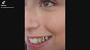 Open Face Heart Grillz Top 2 pc DQ1023